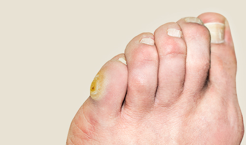 Hühneraugen entfernen Heike Micka 